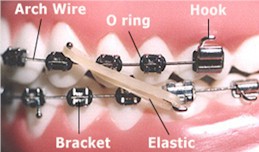 Dental Orthodontic Braces Wire 0.5/ 0.6/ 0.7/ 0.8/ 0.9/ 1.0/ 1.2 mm Arch  Wire